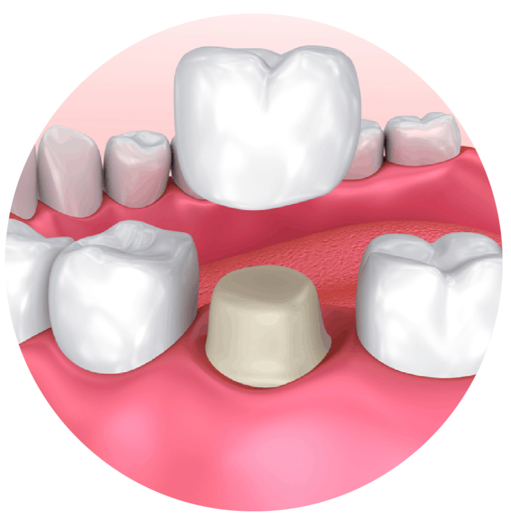 Crowns & Bridges Zoma Dental
