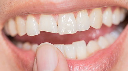 Cracked / Broken Tooth can be fixed at Dentist in West Bloomfield 