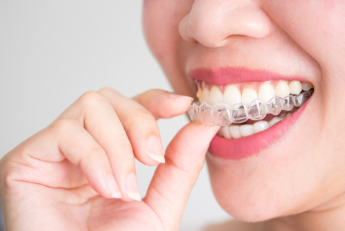 How Invisalign Works