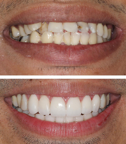 Porcelain Crowns Unsightly
