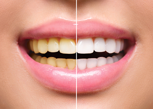 Teeth Whitening Stains