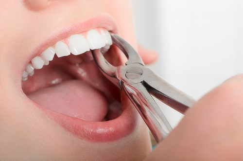 What to expect about Tooth Extraction