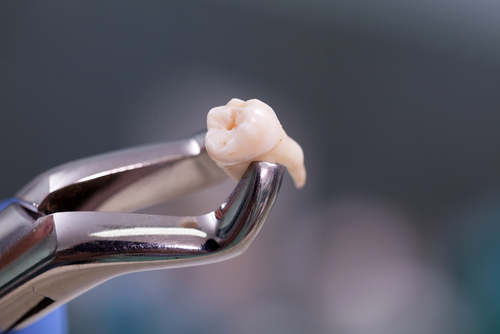 Tooth Extraction Wisdom