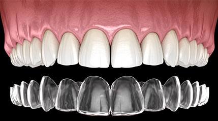 Invisalign
