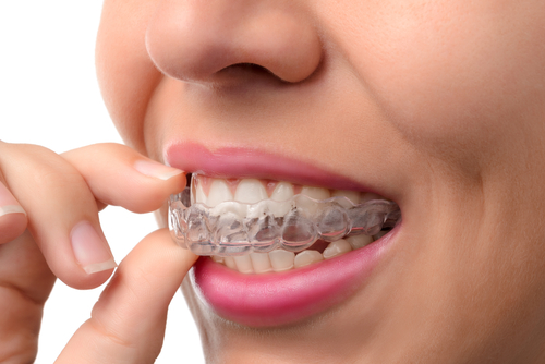 invisible braces