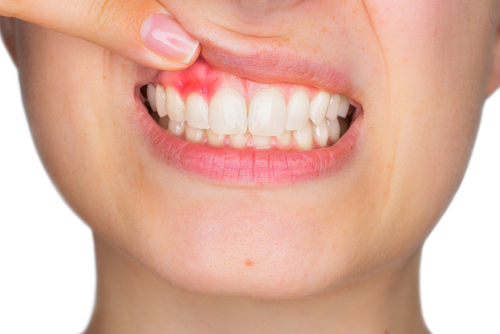 gum disease