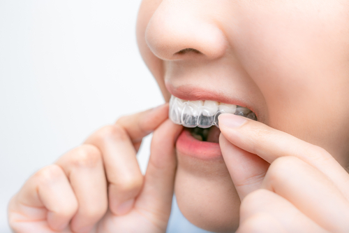 Invisalign cost