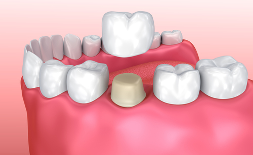 full coverage dental crown