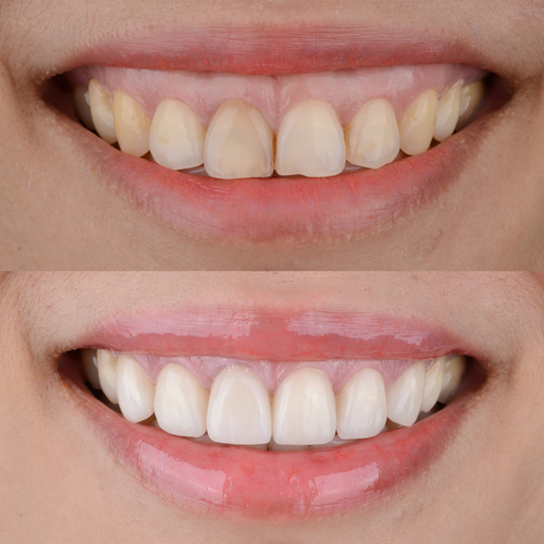 Problems Fixed by Porcelain Veneers 