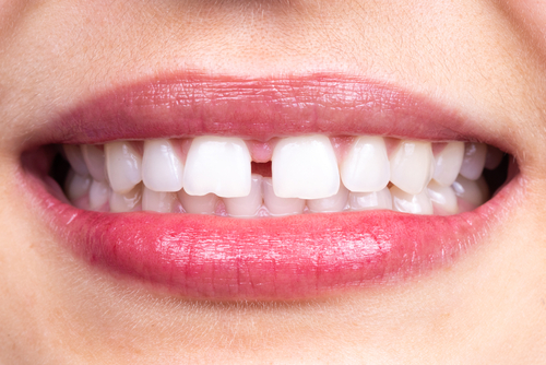 Problems Fixed by Porcelain Veneers