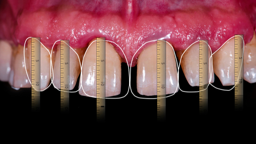 How do I know that veneers will look right on me?