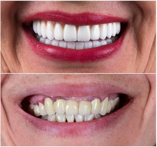 types of porcelain veneers